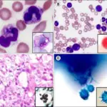 Histoplasma Fungal Infection