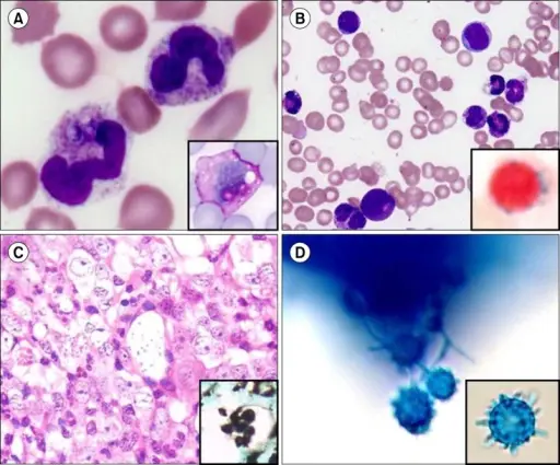 Histoplasma Fungal Infection