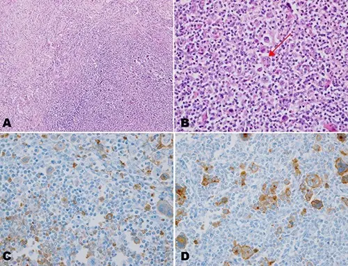 Hodgkin Disease