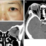 Hormonal Neuropathies