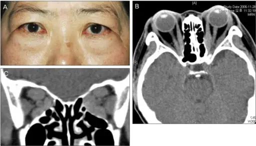 Hormonal Neuropathies