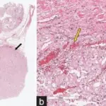 Horseshoe Kidney