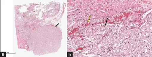 Horseshoe Kidney