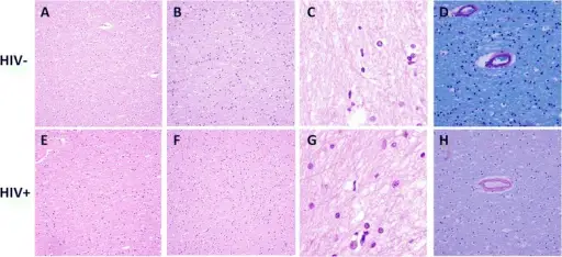 Human Immunodeficiency Virus