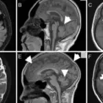 Huntington’s Disease