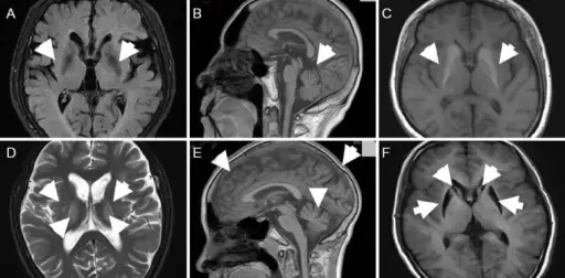 Huntington’s Disease