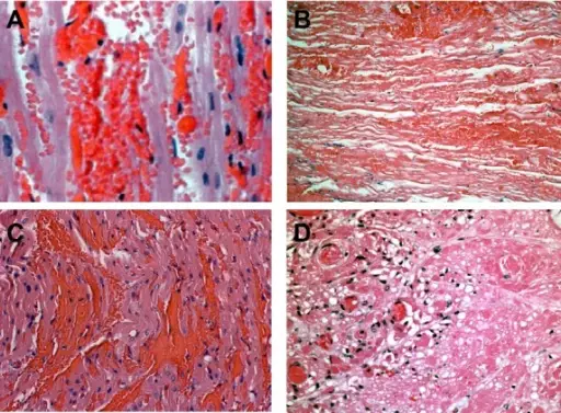 Hyperacute Rejection