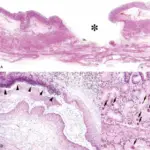 Hyperadrenalism