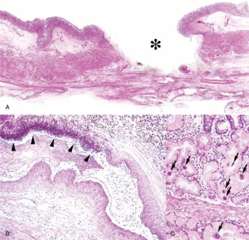 Hyperadrenalism