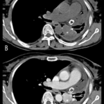 Hyperaldosteronism