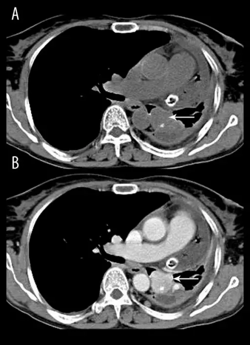 Hyperaldosteronism