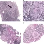 Hypercalcemia Induced Tubulointerstitial Disease