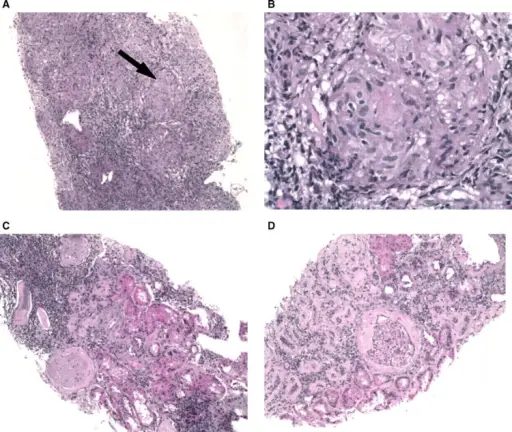 Hypercalcemia Induced Tubulointerstitial Disease