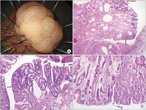 Hyperplastic Polyps