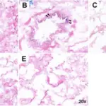 Hypersensitivity Pneumonitis