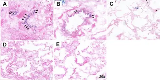 Hypersensitivity Pneumonitis