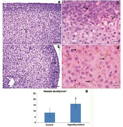 Hyperthyroidism