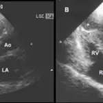 Hypertrophic Cardiomyopathy