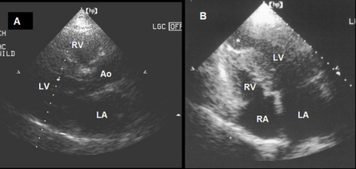 Hypertrophic Cardiomyopathy