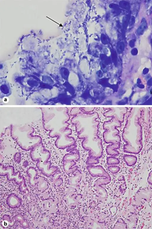 Hypertrophic Gastropathies