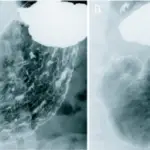 Hypertrophic Gastropathies