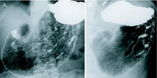 Hypertrophic Gastropathies