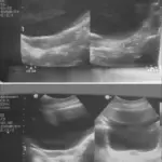 Hypogonadism