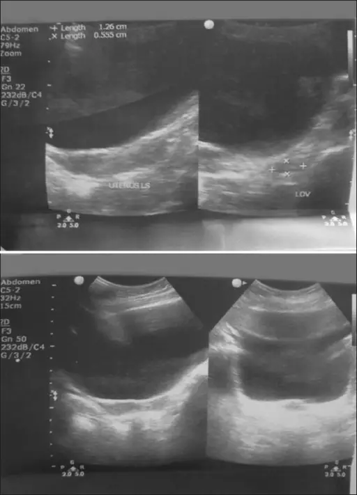 Hypogonadism