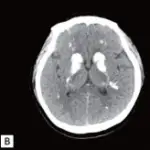 Hypoparathyroidism