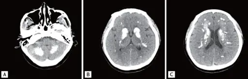 Hypoparathyroidism