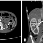 Hypoplasia of the Kidney