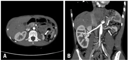 Hypoplasia of the Kidney