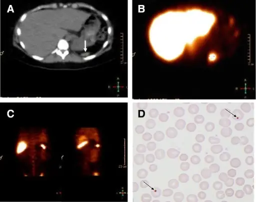 Hyposplenia