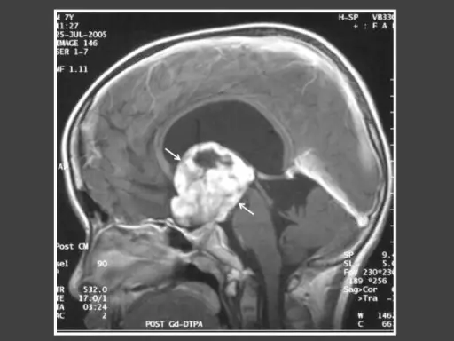 Hypothalamic Suprasellar Tumors