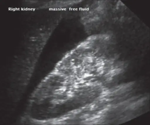 Hypovolemic Shock