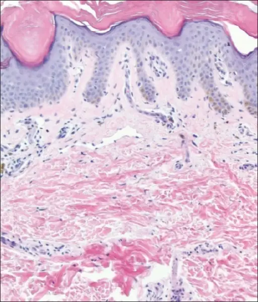 Ichthyosis