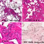 Idiopathic Pulmonary Fibrosis