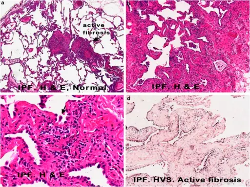 Idiopathic Pulmonary Fibrosis