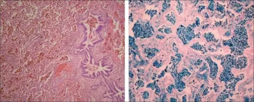 Idiopathic Pulmonary Hemosiderosis