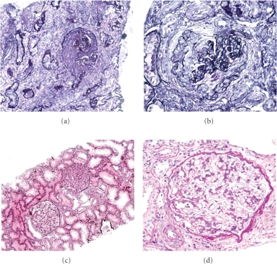 IgA Deficiency