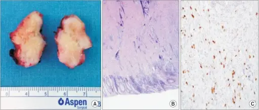 IgG4-Related Disease