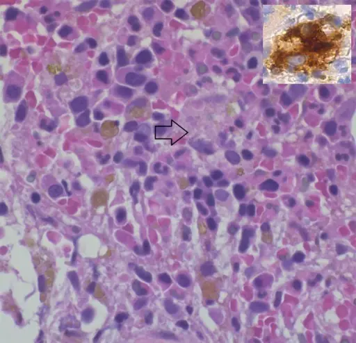 Immune Complex-Associated Vasculitis