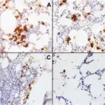 Immunohemolytic Anemia