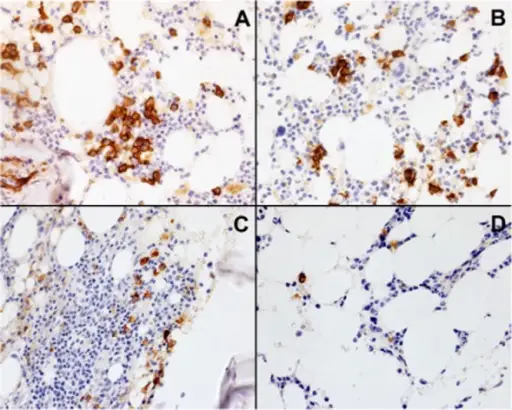 Immunohemolytic Anemia