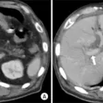 Impaired Blood Flow Into The Liver