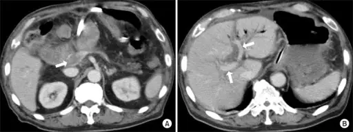 Impaired Blood Flow Into The Liver