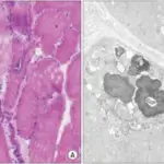 Inclusion Body Myositis