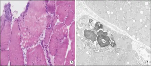 Inclusion Body Myositis