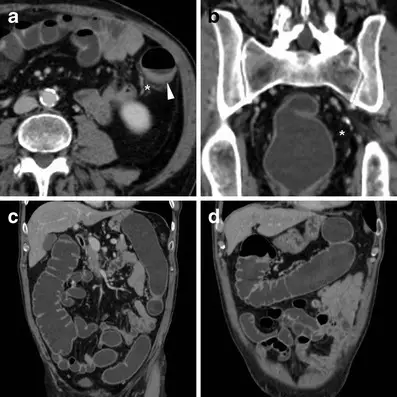 Indeterminate Colitis