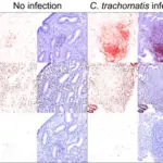 Infections Involving the Upper and Lower Genital Tract